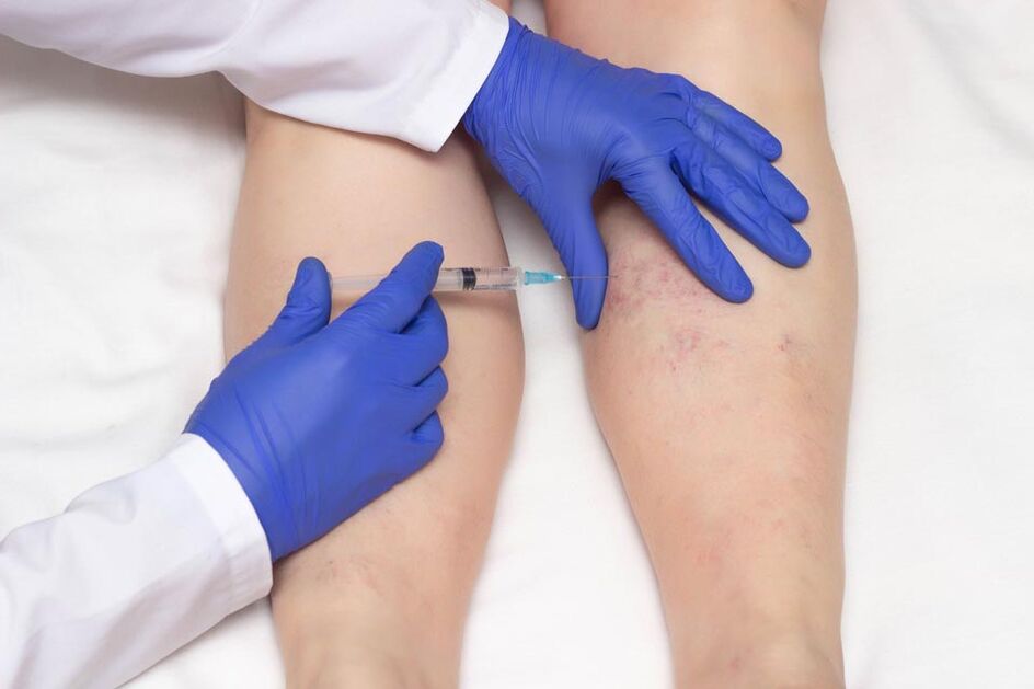 Sclerotherapie is een methode om spataderen te behandelen