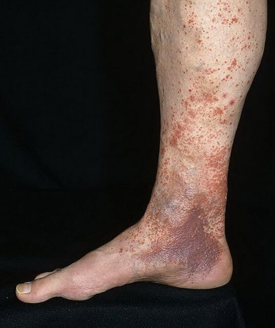 Sparicose dermatitis