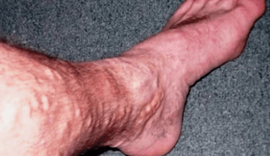 oorzaken van spataderen op de benen bij mannen