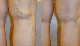 tekenen en symptomen van spataderen op de benen bij mannen