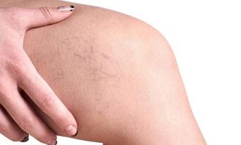 ontwikkelingsstadia van spataderen