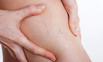 redenen voor de ontwikkeling van spataderen in de benen