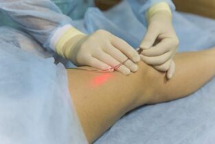 laserbehandeling van spataderen de essentie van de procedure