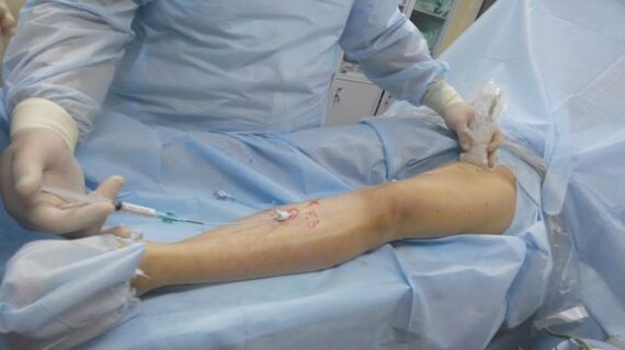 operatie voor spataderen op de benen