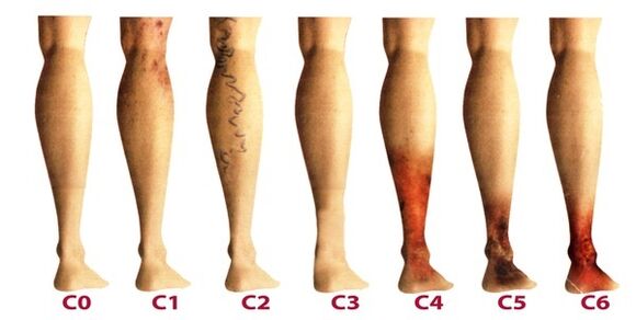 stadia van ontwikkeling van spataderen op de benen