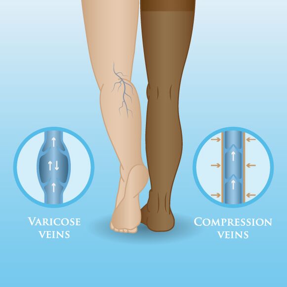 Effecten van compressiekleding op spataderen in de benen