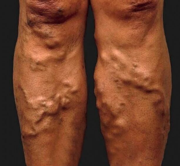 verwaarloosde spataderen op de benen