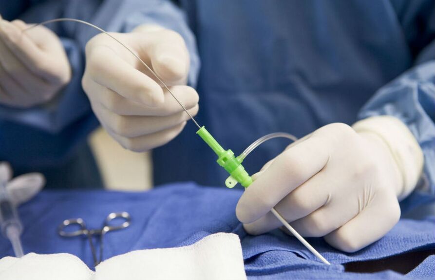 chirurgische behandeling van spataderen