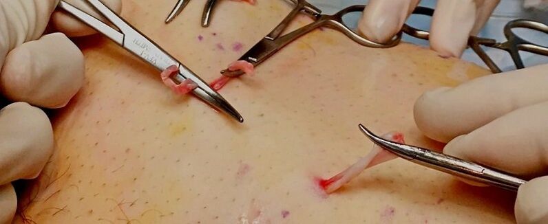 chirurgische behandeling van spataderen op de benen bij mannen