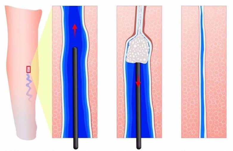 sclerotherapie voor spataderen in de benen bij mannen