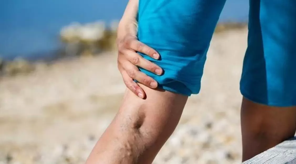 Uitpuilende blauwe aderen op de benen zijn een teken van spataderen